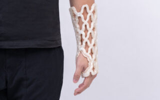 Castomize Develops 4D Printed Orthopaedic Casts With Remouldable Smart Material