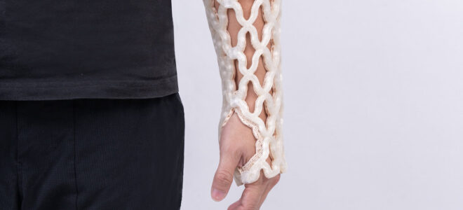 Castomize Develops 4D Printed Orthopaedic Casts With Remouldable Smart Material